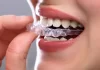 Smiling adult showing clear invisible aligners for teeth correction, highlighting top 7 reasons