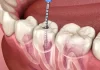 common-myths-vs-facts-root-canal-treatment-hinjewadi