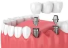 Benefits of Dental Implants Over Dentures & Bridges