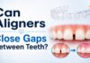 Can Aligners Close Gaps Between Teeth?